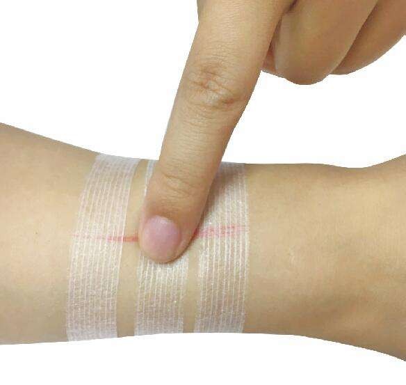 Wound Closure Strip