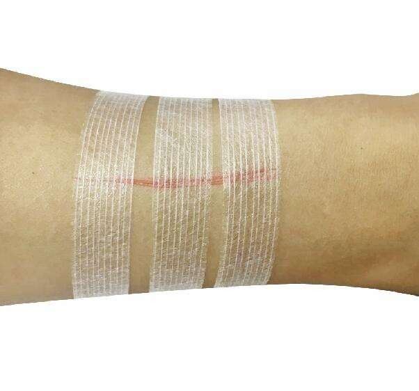 Wound Closure Strip