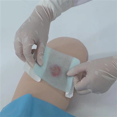 Ohraničený hydrogelový obvaz na drobné popáleniny